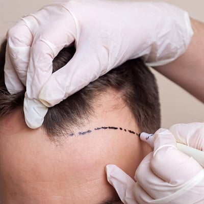 Can a hair transplant lead to cancer