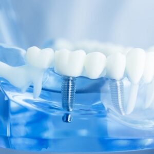Do Dental Implants Remain Safe Over Time?