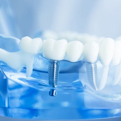 Do Dental Implants Remain Safe Over Time