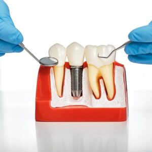 How should I take care of my dental implants?