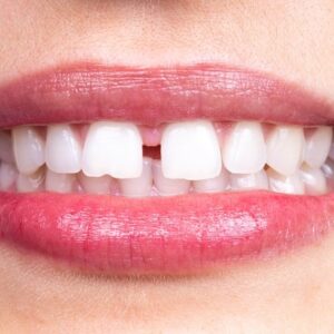 How to narrow a tooth gap without using braces.