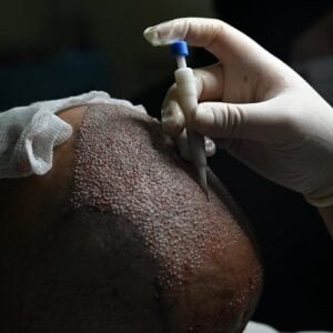 Is It Safe to Exercise After a Hair Transplant?