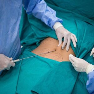 What is the safest Liposuction method