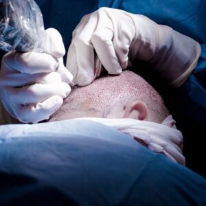 The advancement of hair transplantation in Islamabad