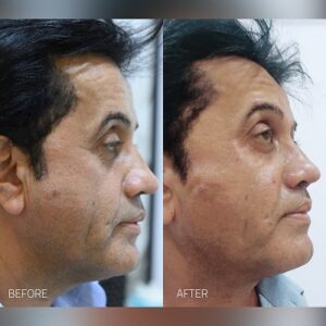 Thread Lift Treatment islamabad