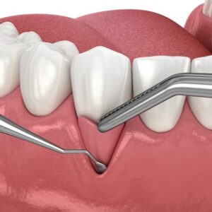 What are the different types of gum grafts? 