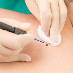 What are the three most popular techniques for mole removal?
