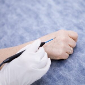 What is the most effective wart removal treatment in Islamabad?