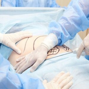 What is the safest Liposuction method