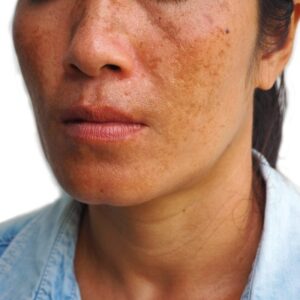 Which Doctor is best for melasma treatment in Islamabad