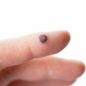 Why SKN is known to be the best clinic for warts removal in Islamabad?