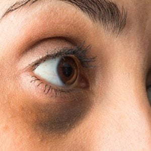Can Dark Circles be Permanently Removed?