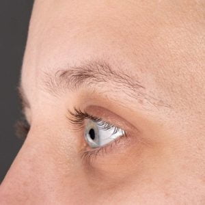 Eyebrow hair transplant for alopecia areata in Islamabad
