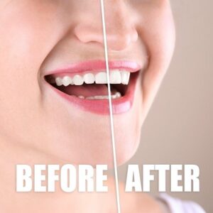 How painful is Laser Gum Surgery?