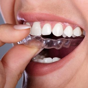 How to clean teeth aligners in Islamabad