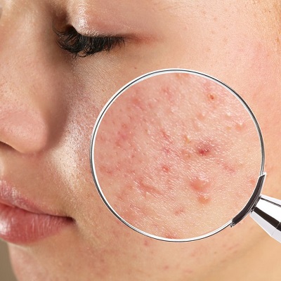 Permanent Acne Scars Treatment in Islamabad Pakistan