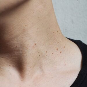 What is the Best Yet most Effective Option for Skin Tag Removal?