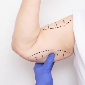 Which technique is ideal for sagging arms?