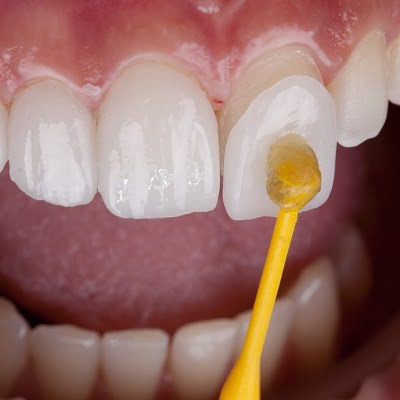 what to look for to find the best dental veneers in Islamabad