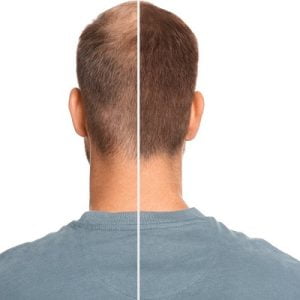 Actions to take if your hair falls out