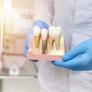Can Dental Implants Be Done In A Day?