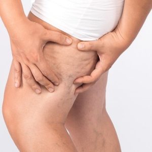 Most effective method for removing cellulite from your legs