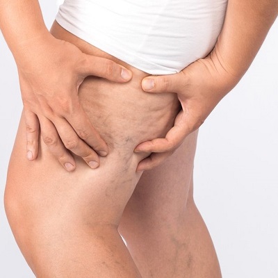 What is the most effective method for removing cellulite from your legs?