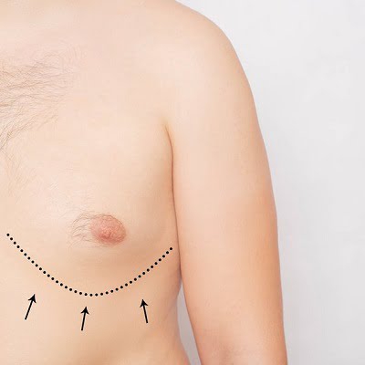 How Can I Get Rid Of Gynecomastia