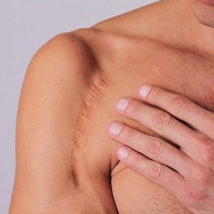 How can I get scars off my body for good?