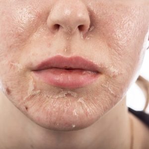 How do chemical peels enhance the appearance of your skin?