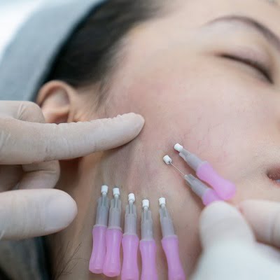 Is a thread lift a better option than Fillers