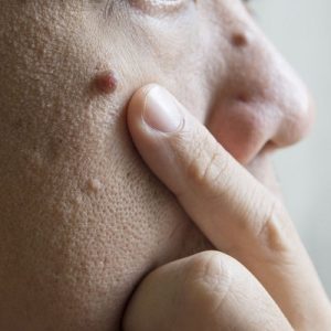 The don’ts and do’s of mole removal