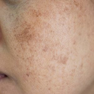 What Is The Best Treatment To Remove Pigment?