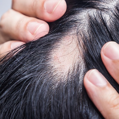 How does alopecia areata impact your daily life?