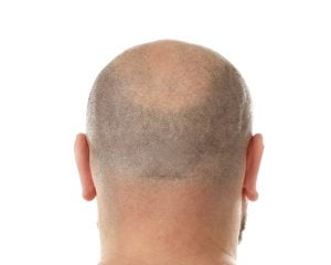 Can Hair Be Transplanted On Crown Area?