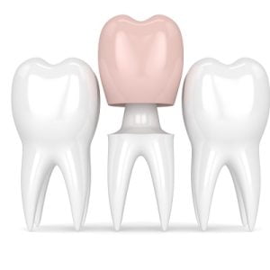 Why Would I Need a Dental Crown?