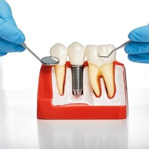 What Keeps Dental Implants in Place?