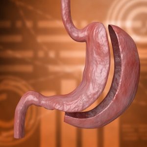 Is Gastric Sleeve A High-Risk Surgery in Islamabad