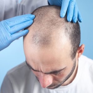 Real-life stories of hair transplant