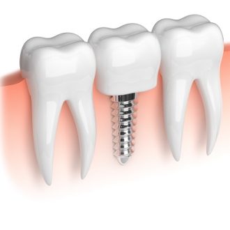Do Dental Implants Ever Slip Out?
