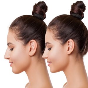After jaw surgery, does the bone regenerate?