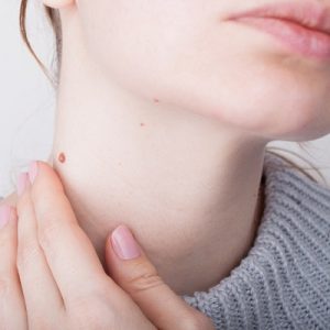 How to Remove Warts With Laser Therapy