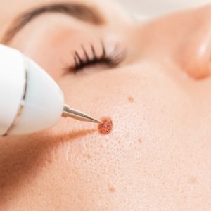 How long do warts typically take to heal after being removed?