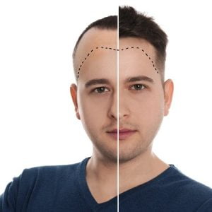 Hair Transplantation and Treatments