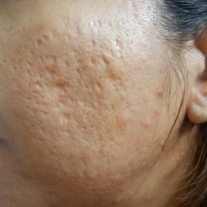 How Effective Are Laser Therapies For Acne Scars?