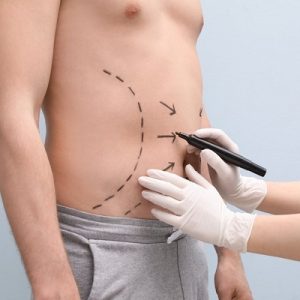 Maintaining Your Results After Liposuction