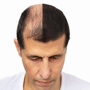 Natural-Looking Results: How FUE Hair Transplant Can Restore Your Confidence.
