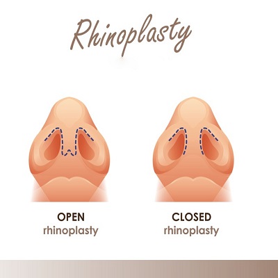 Open Rhinoplasty For Deviated Septum in Islamabad