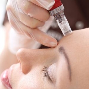 The Importance of Choosing a Qualified Microneedling Practitioner