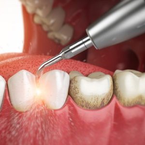 The Importance of Regular Teeth Cleaning: Benefits and Risks